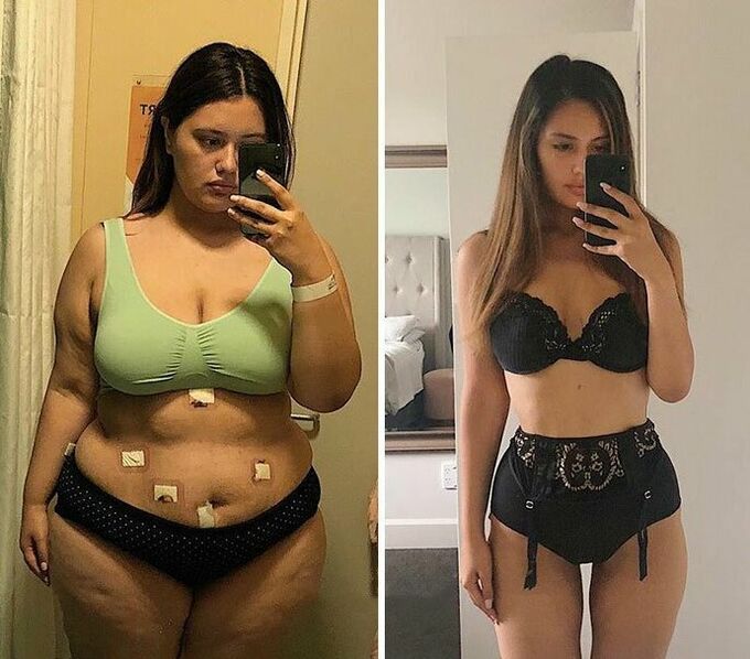 Chica antes y después de la pérdida de peso con cápsula KETO Complete